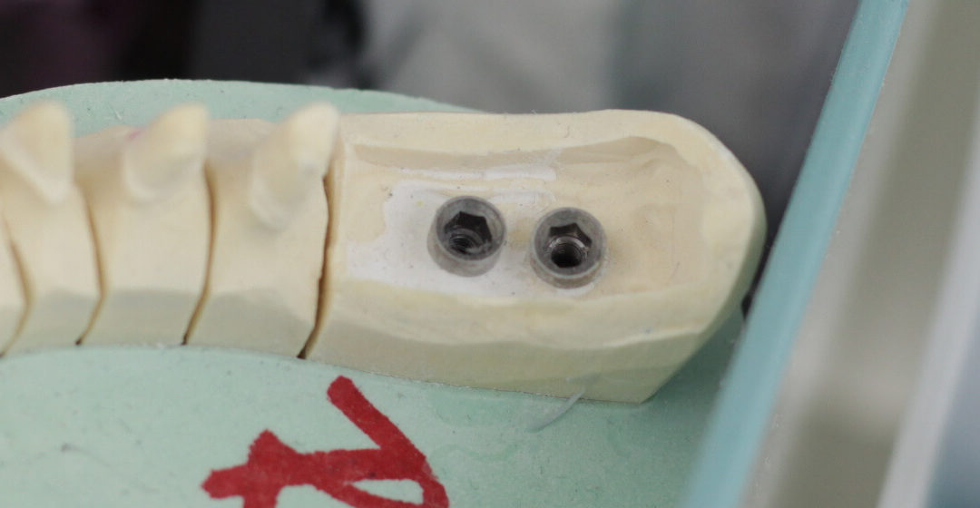 Fogászati implantátumok tartóssága