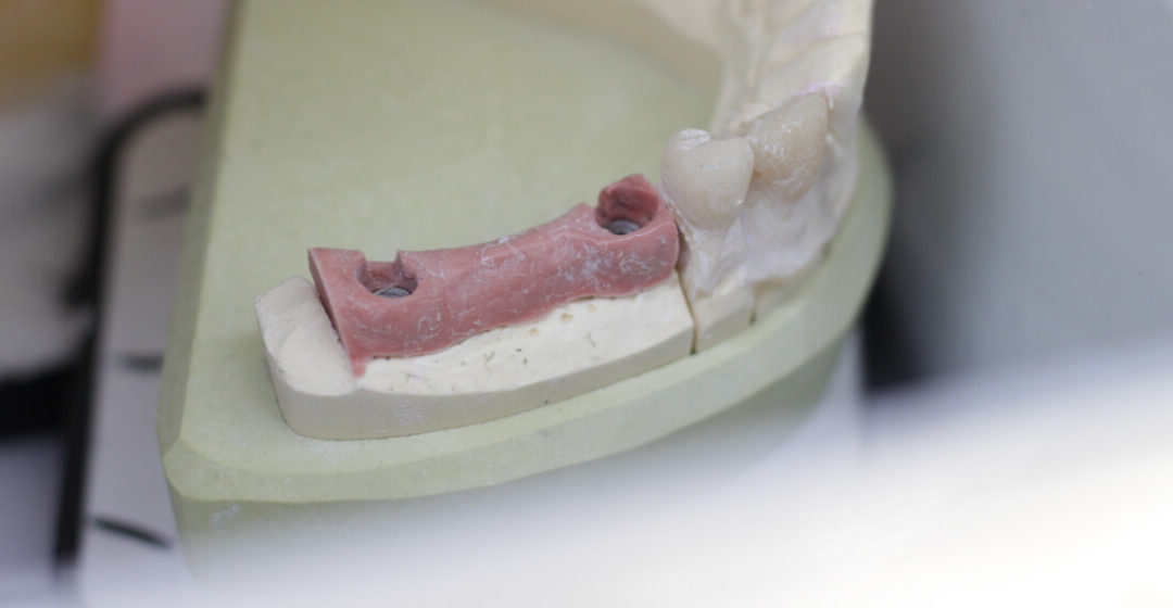 Fogászati implantátum TB