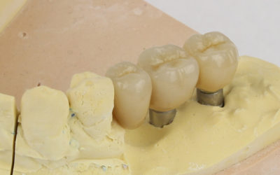 Haltbarkeit von Zahnimplantaten